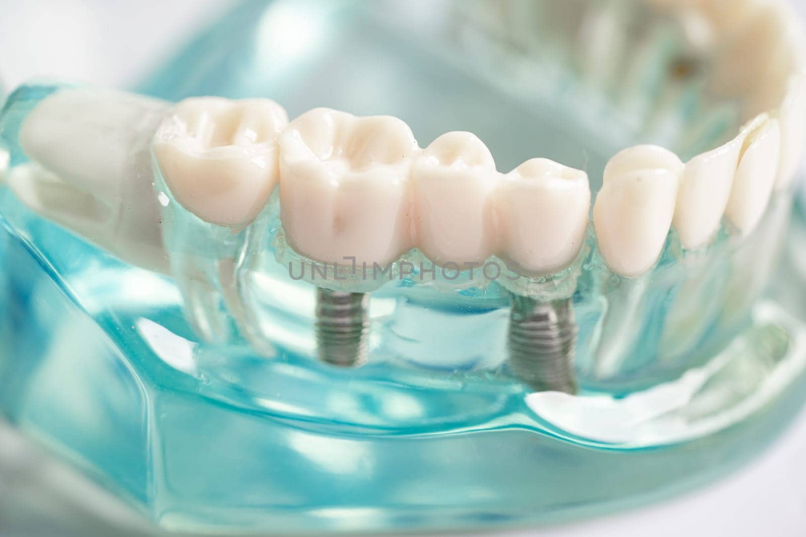 Dental implant, artificial tooth roots into jaw, root canal of dental treatment, gum disease, teeth model for dentist studying about dentistry. by pamai