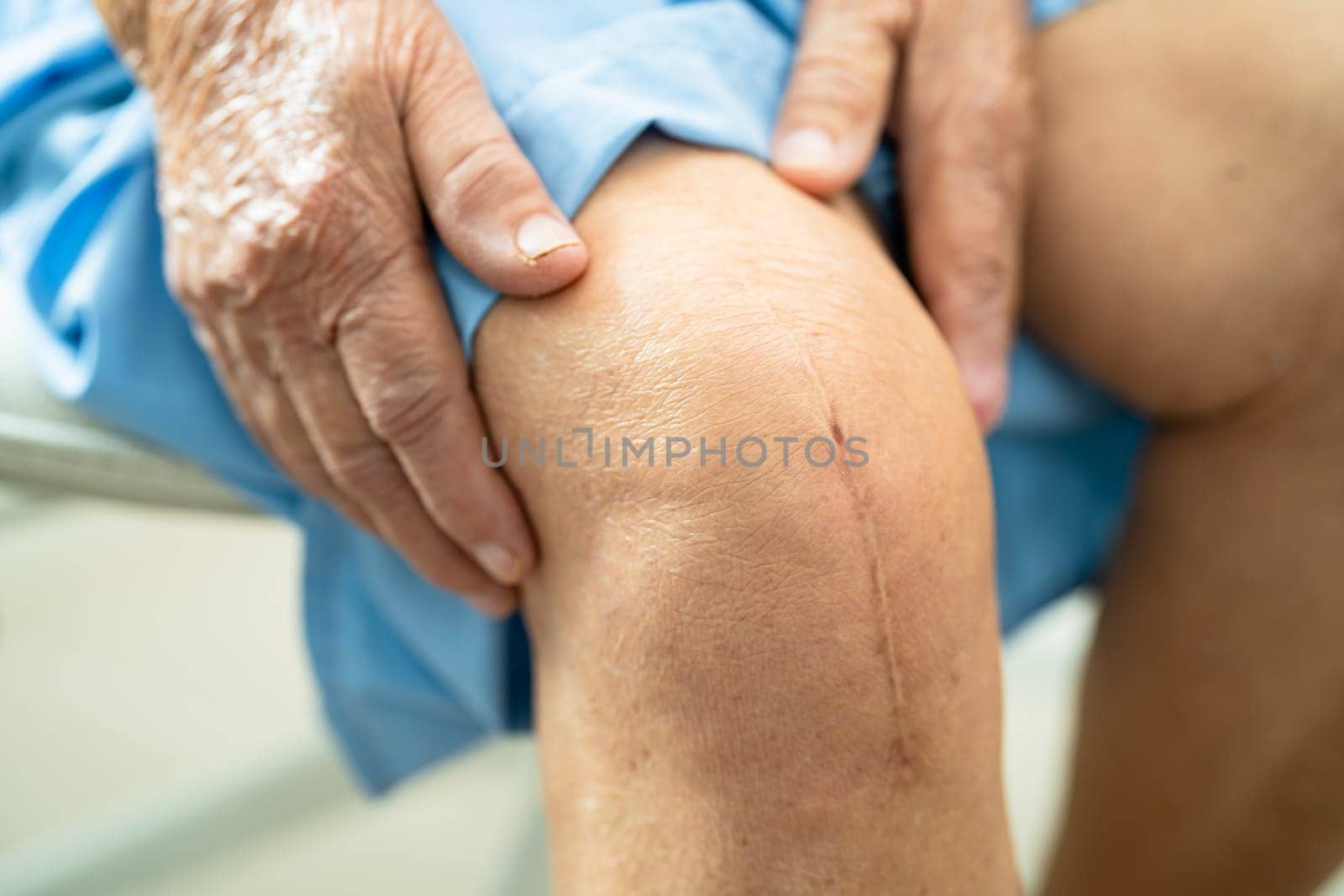 Asian elderly woman patient show her scars surgical total knee joint replacement Suture wound surgery arthroplasty on bed in hospital. by pamai