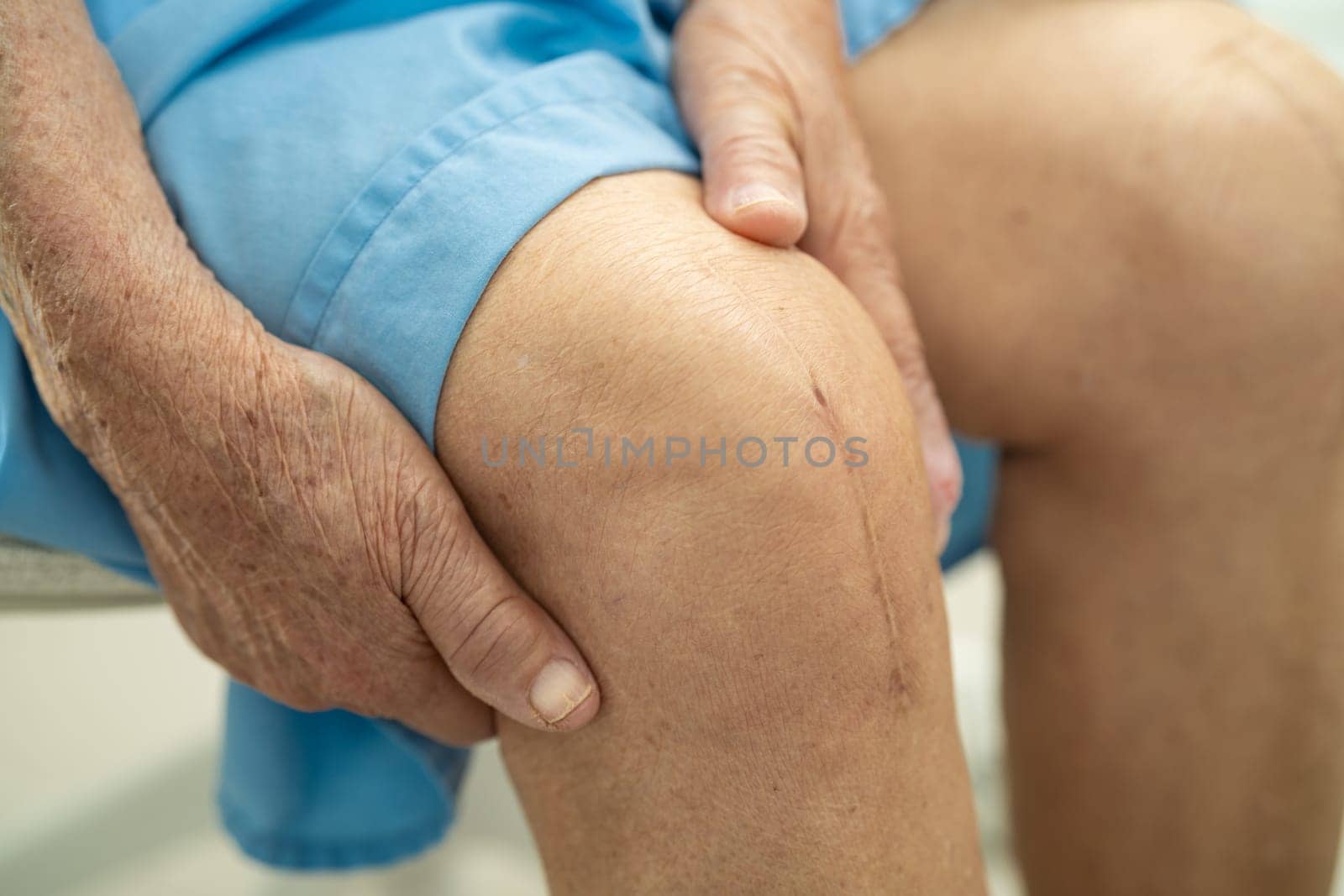 Asian elderly woman patient show her scars surgical total knee joint replacement Suture wound surgery arthroplasty on bed in hospital.