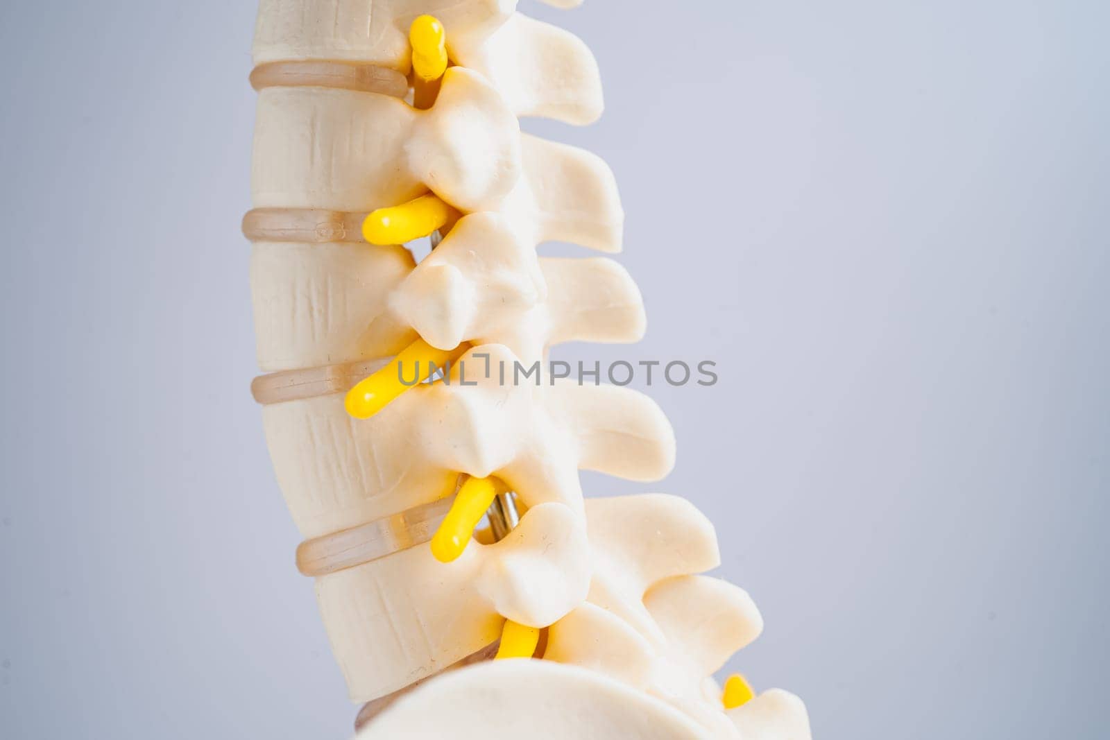 Lumbar spine displaced herniated disc fragment, spinal nerve and bone. Model for treatment medical in the orthopedic department. by pamai