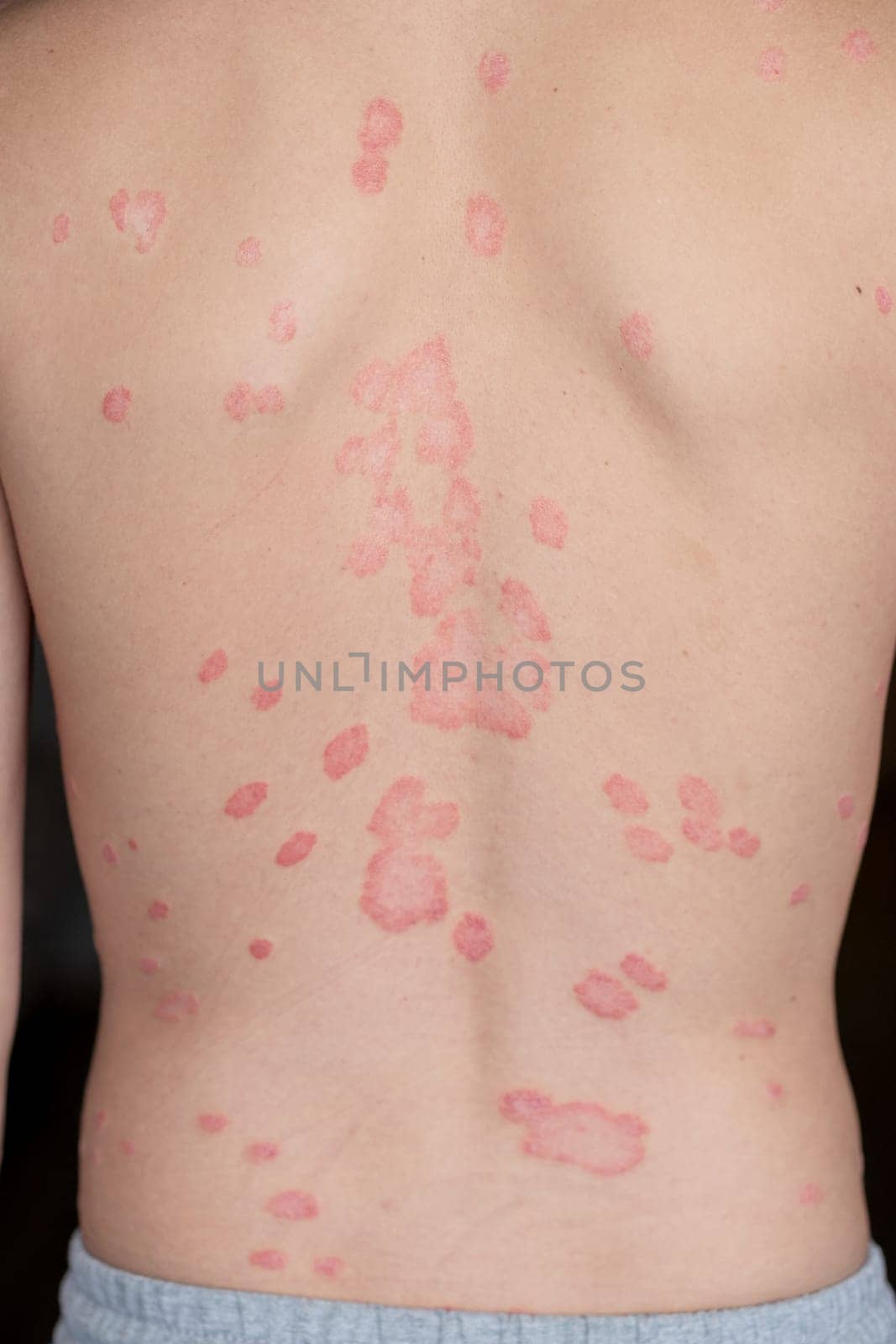 Psoriasis Vulgaris, skin patches are typically red, itchy, and scaly. by AnatoliiFoto