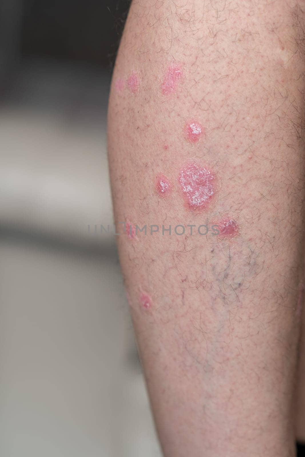 Psoriasis Vulgaris, skin patches are typically red, itchy, and scaly. Papules of chronic psoriasis vulgaris on male hand, back and body. Genetic immune disease. Detail of psoriatic skin disease