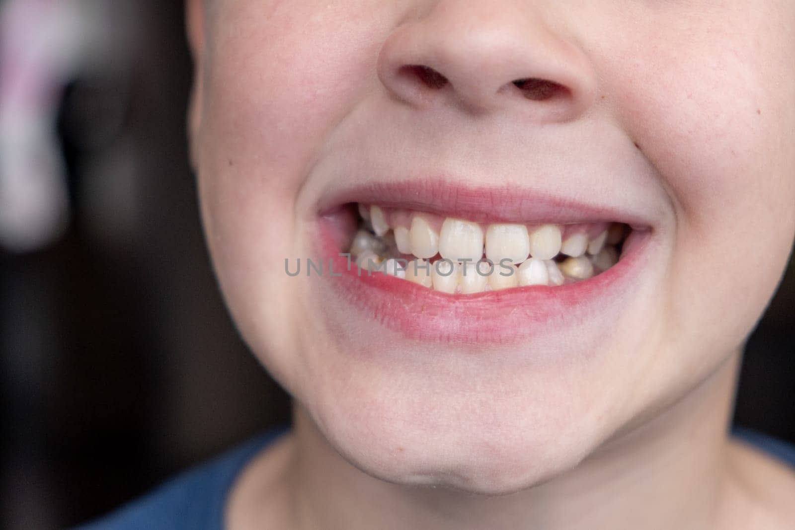 Child's crooked teeth. Young man showing crooked growing teeth. by AnatoliiFoto