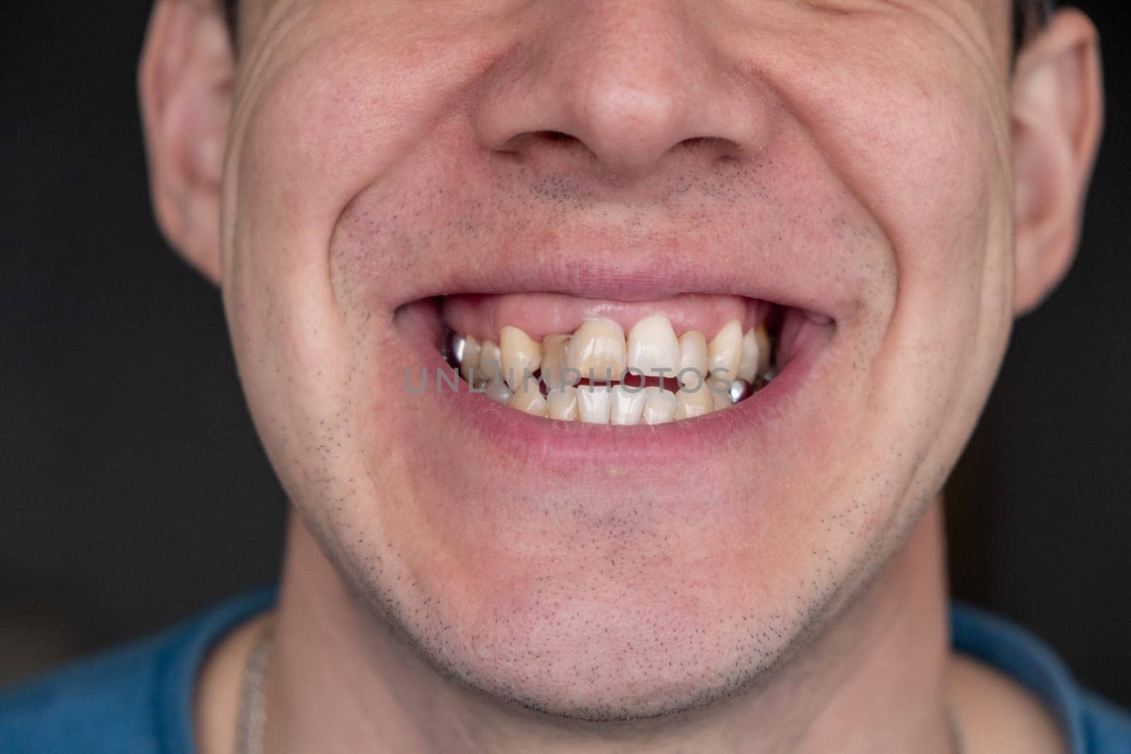 A man's crooked teeth. Young man showing crooked growing teeth. by AnatoliiFoto