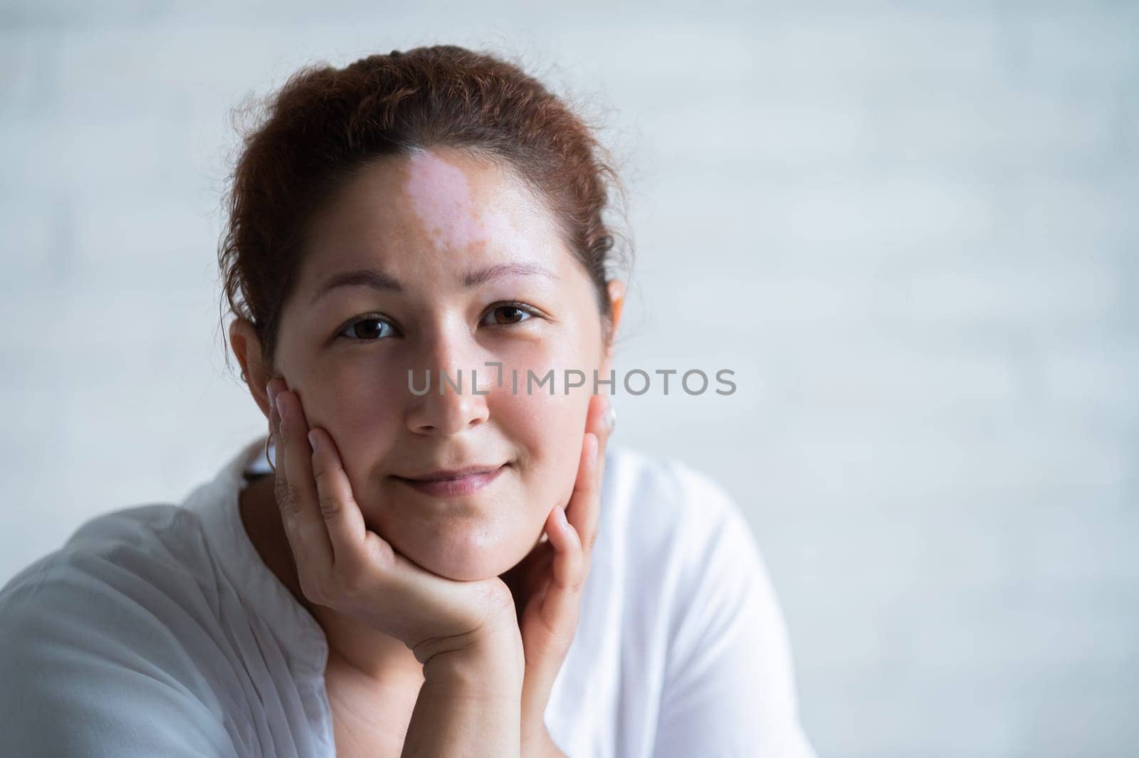 Portrait of a smiling woman with Vitiligo Disease