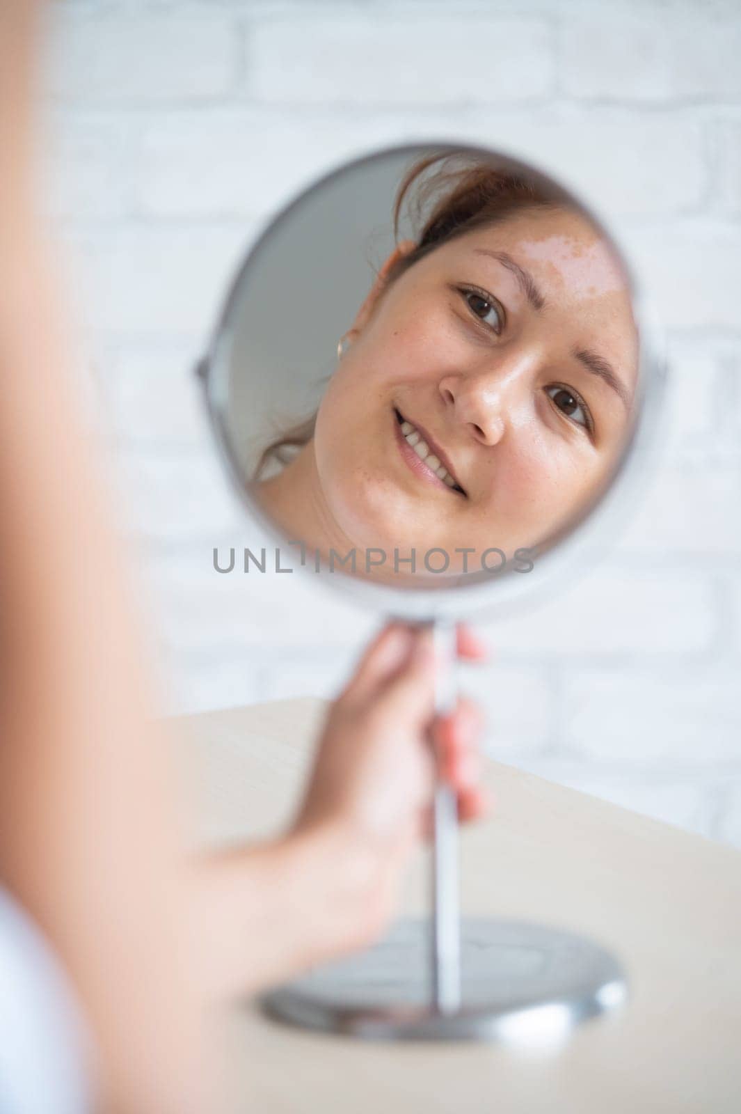 A woman with vitiligo disease looks in the mirror