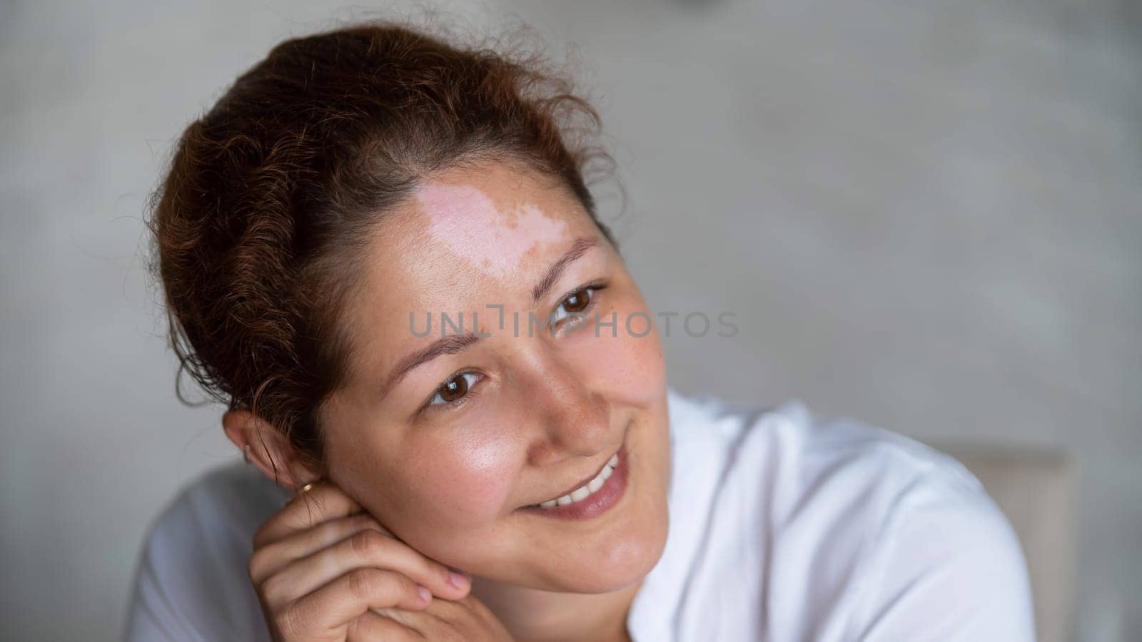 Portrait of a smiling woman with Vitiligo Disease. by mrwed54