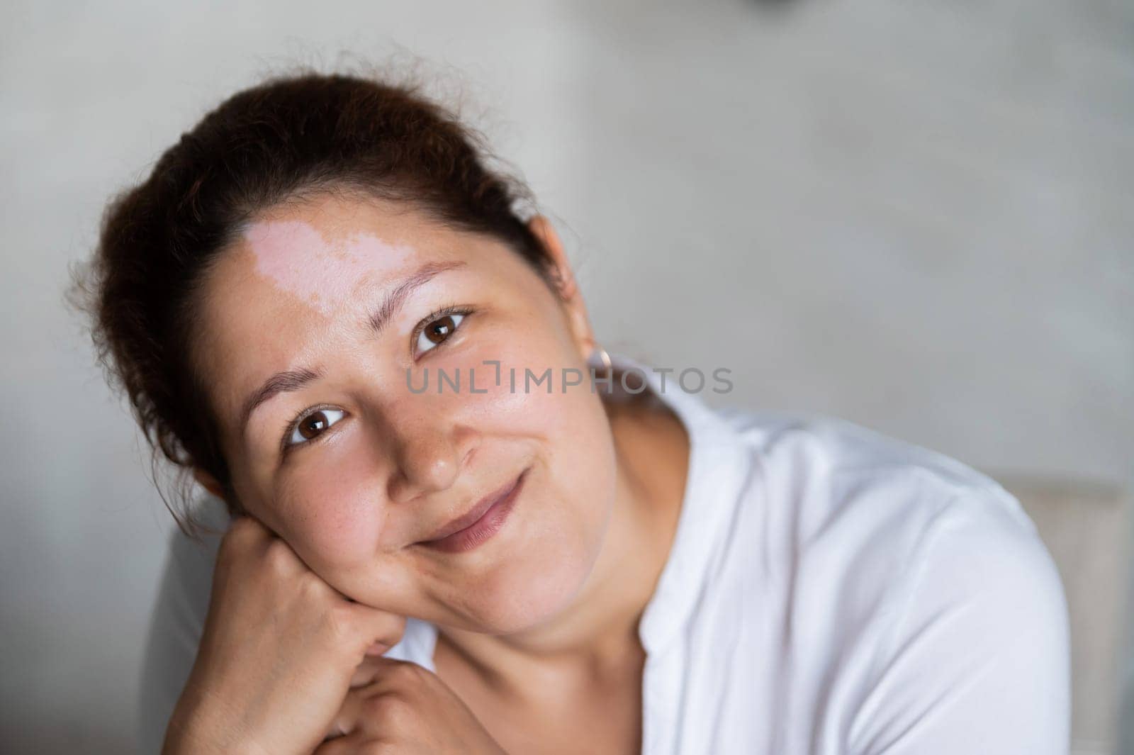 Portrait of a smiling woman with Vitiligo Disease