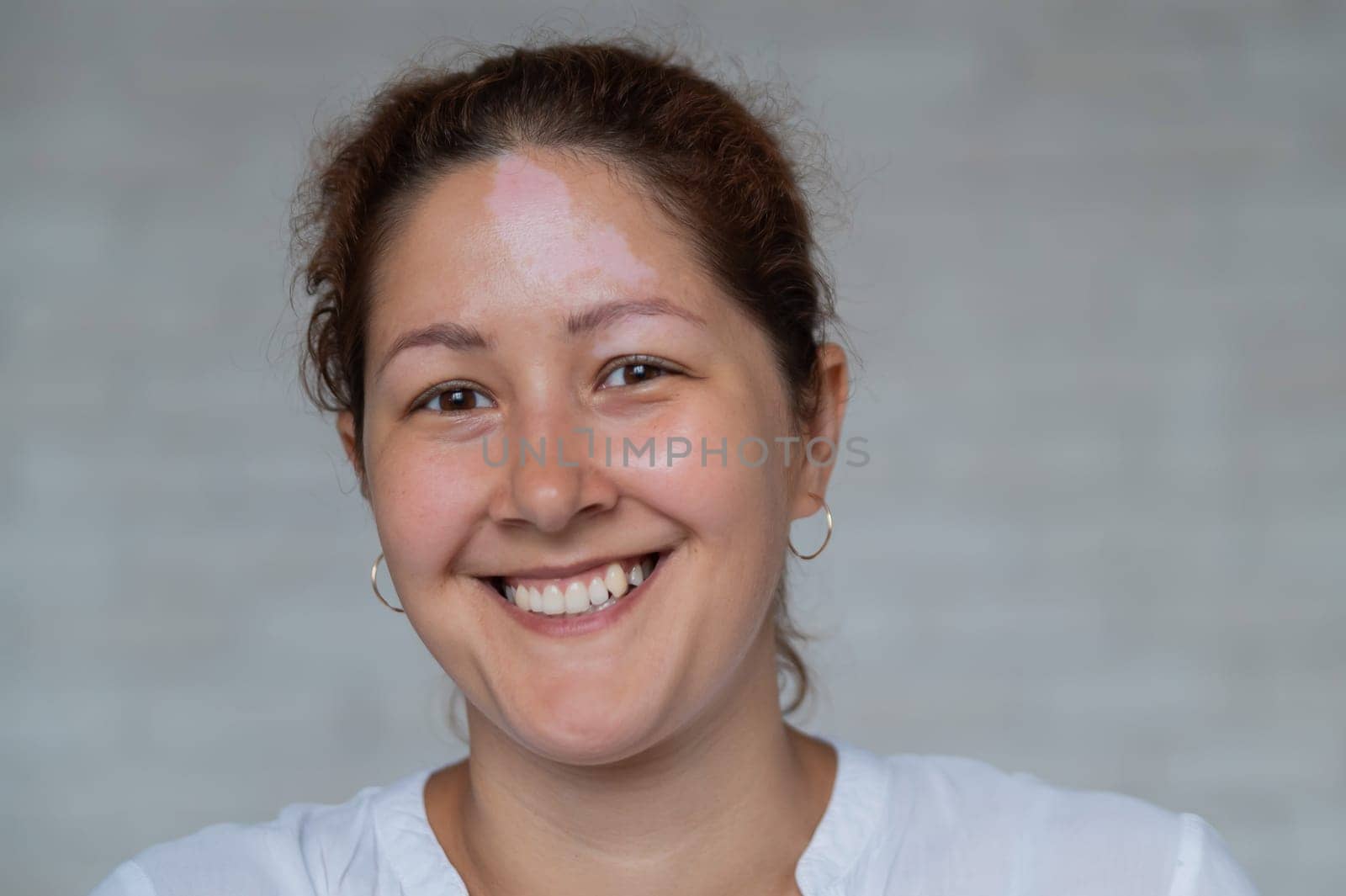 Smiling girl with an autoimmune disease affecting the skin. Portrait of a woman with a pigmented spots of vitiligo on his forehead