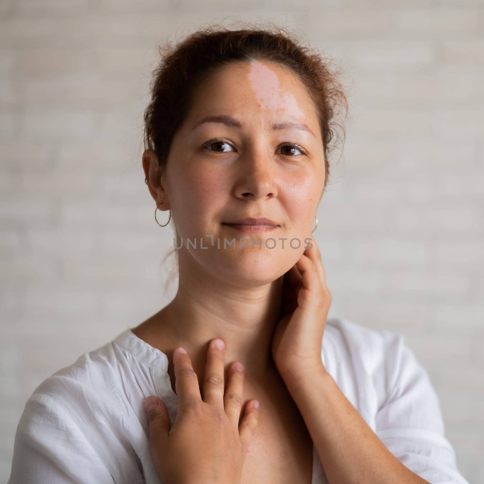 Vitiligo. Portrait of a beautiful smiling woman with lack of skin pigmentation on her forehead. A girl with a white spot on her face. Autoimmune disease. by mrwed54