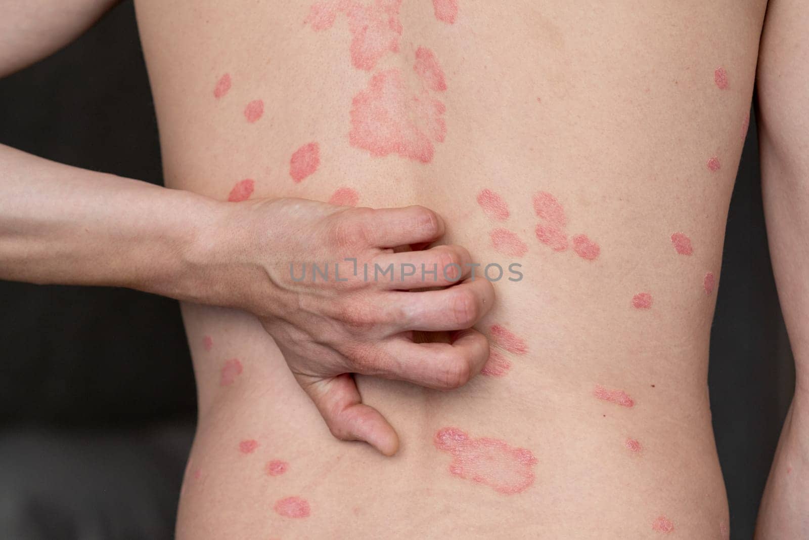 Psoriasis Vulgaris, skin patches are typically red, itchy, and scaly. Papules of chronic psoriasis vulgaris on male hand, back and body. Genetic immune disease. Detail of psoriatic skin disease