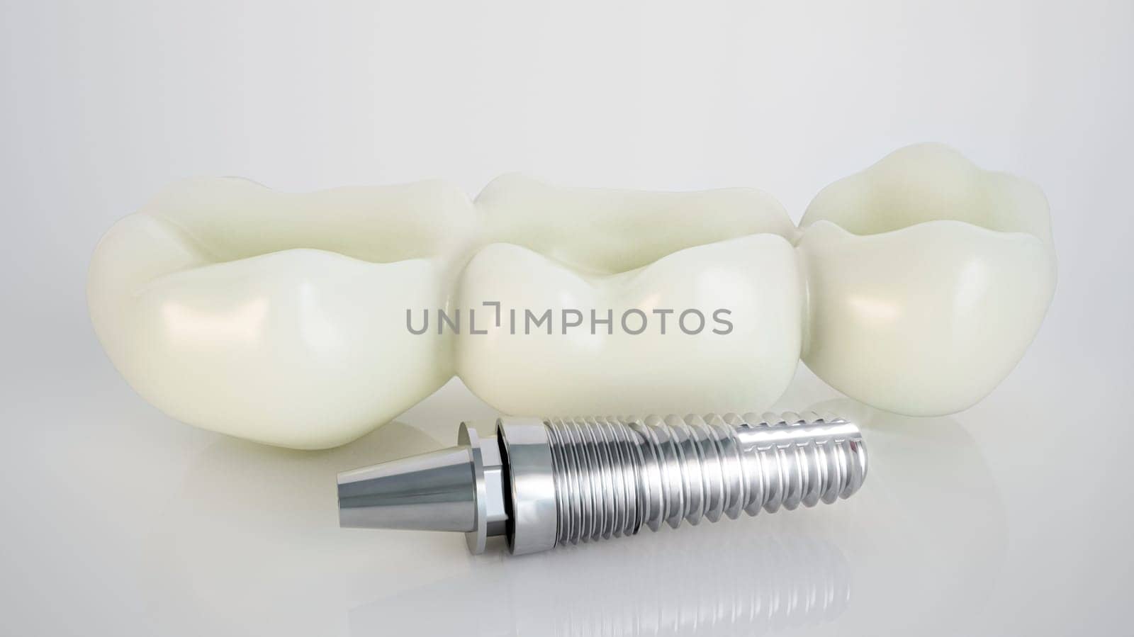 Dental Implant: Modern Solution for Tooth Replacement by Crevis