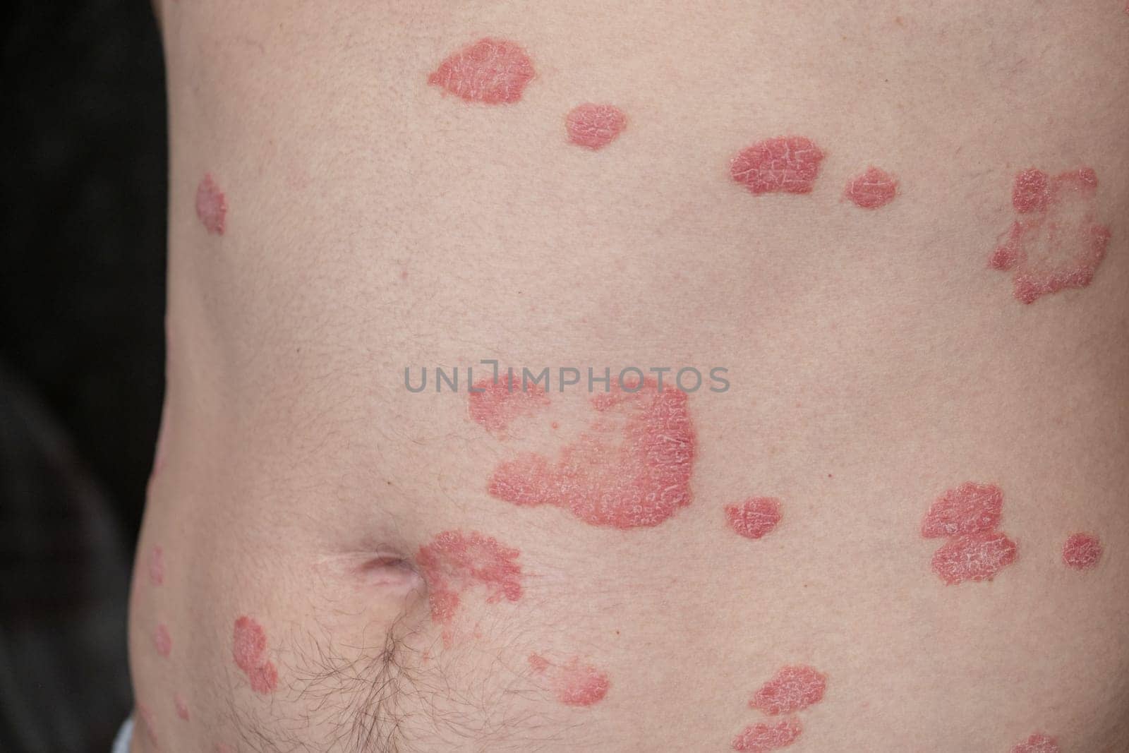 Psoriasis Vulgaris, skin patches are typically red, itchy, and scaly. Papules of chronic psoriasis vulgaris on male hand, back and body. Genetic immune disease. Detail of psoriatic skin disease