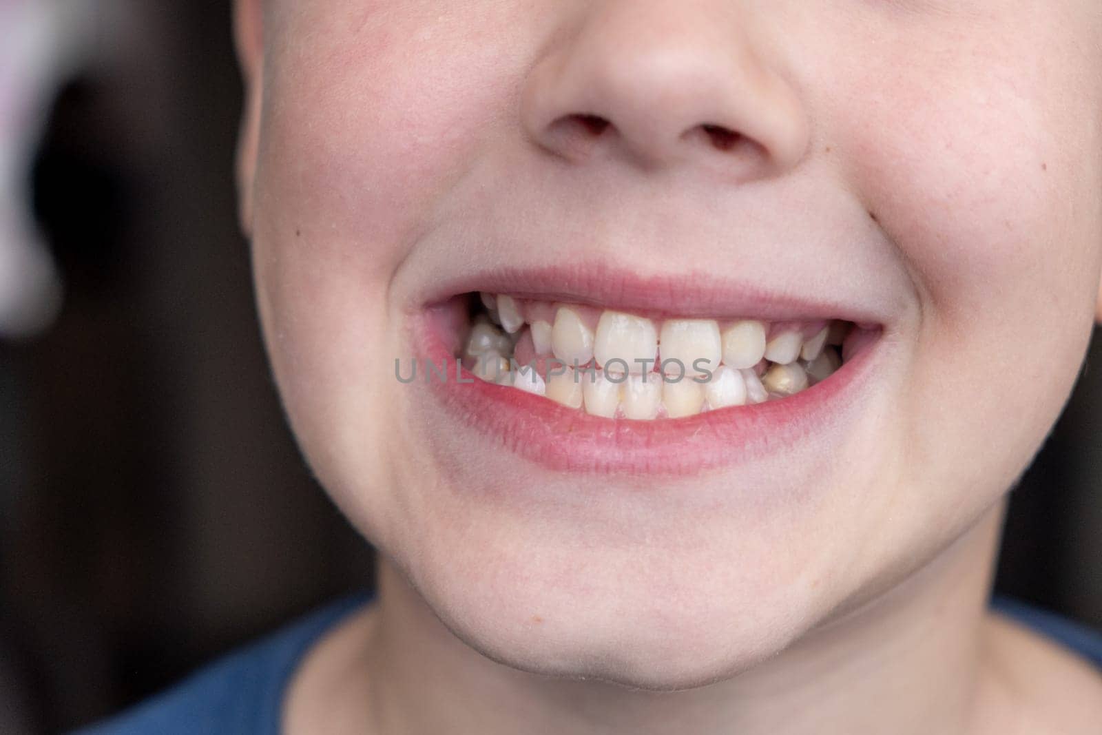 Child's crooked teeth. Young man showing crooked growing teeth. by AnatoliiFoto
