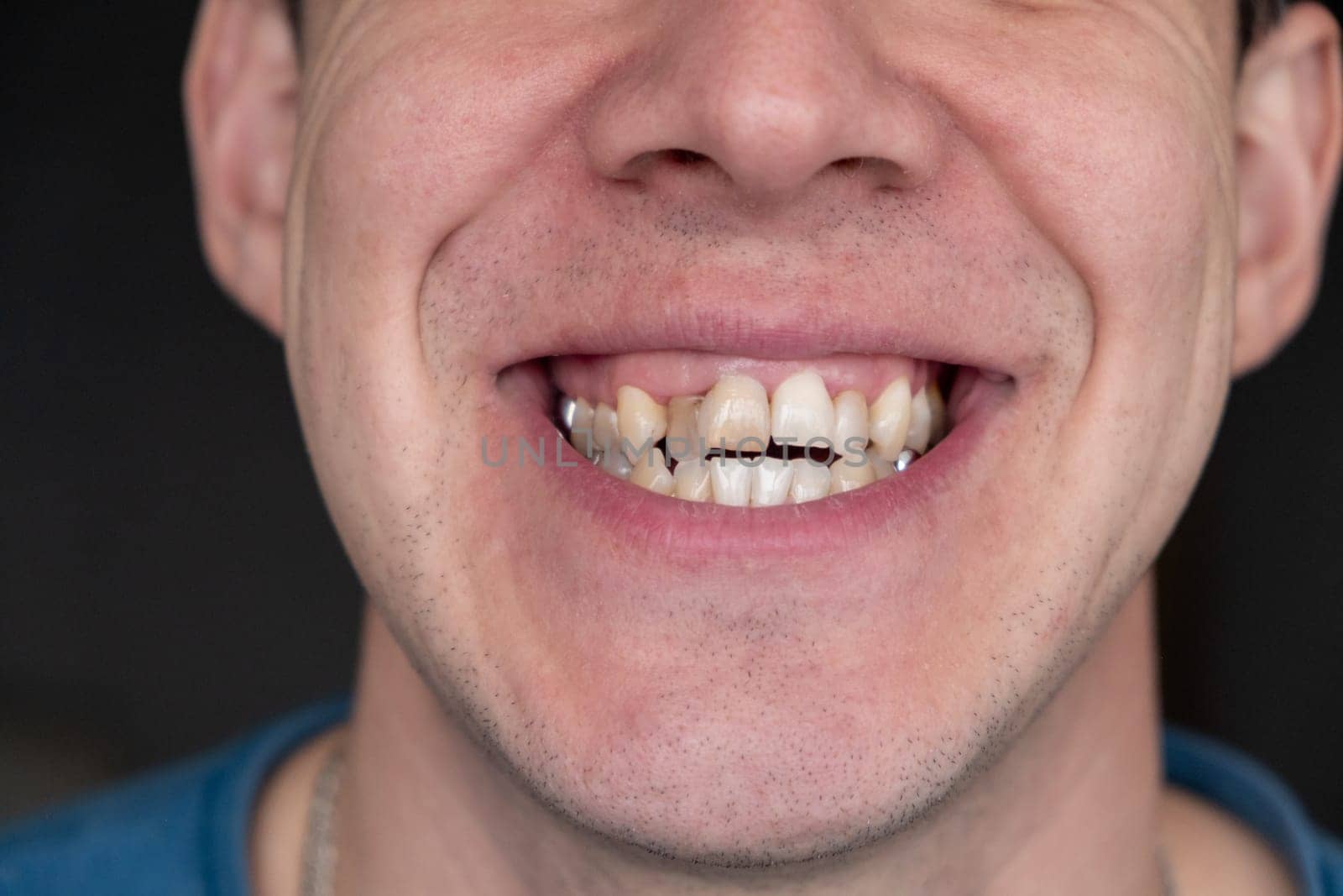 A man's crooked teeth. Young man showing crooked growing teeth. The man needs to go to the dentist to install braces.