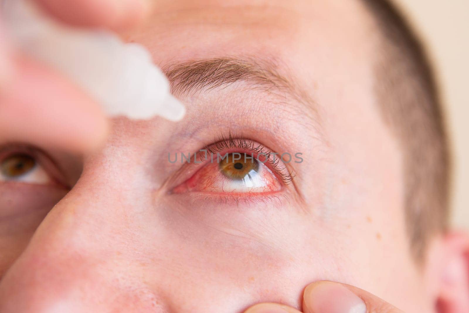 Take care of his eyes. Portrait of a young man with a very red eye dripping drops into his eyes. Close-up. by sfinks