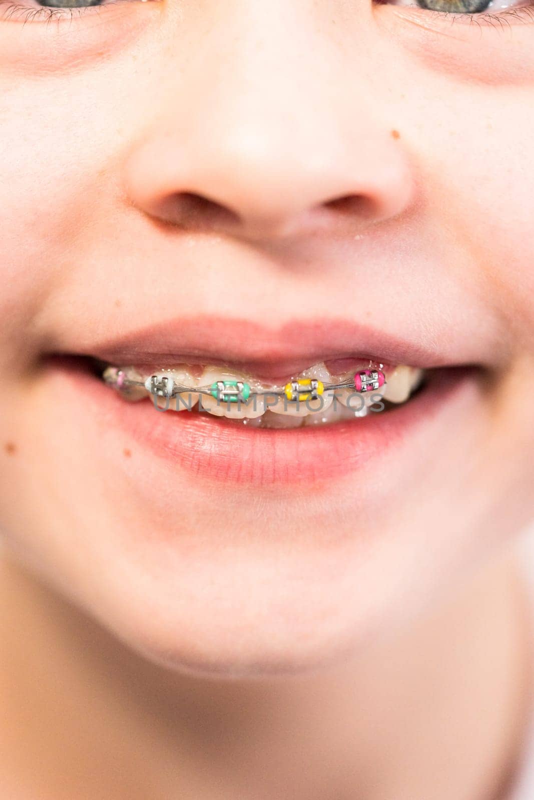 Close-up of the mouth of a girl with rainbow braces.