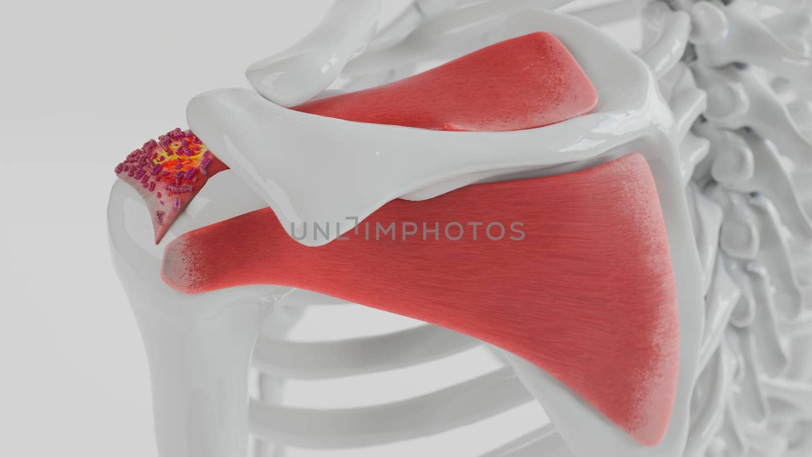 3D Rendering of Calcific Tendonitis in the Shoulder by Crevis