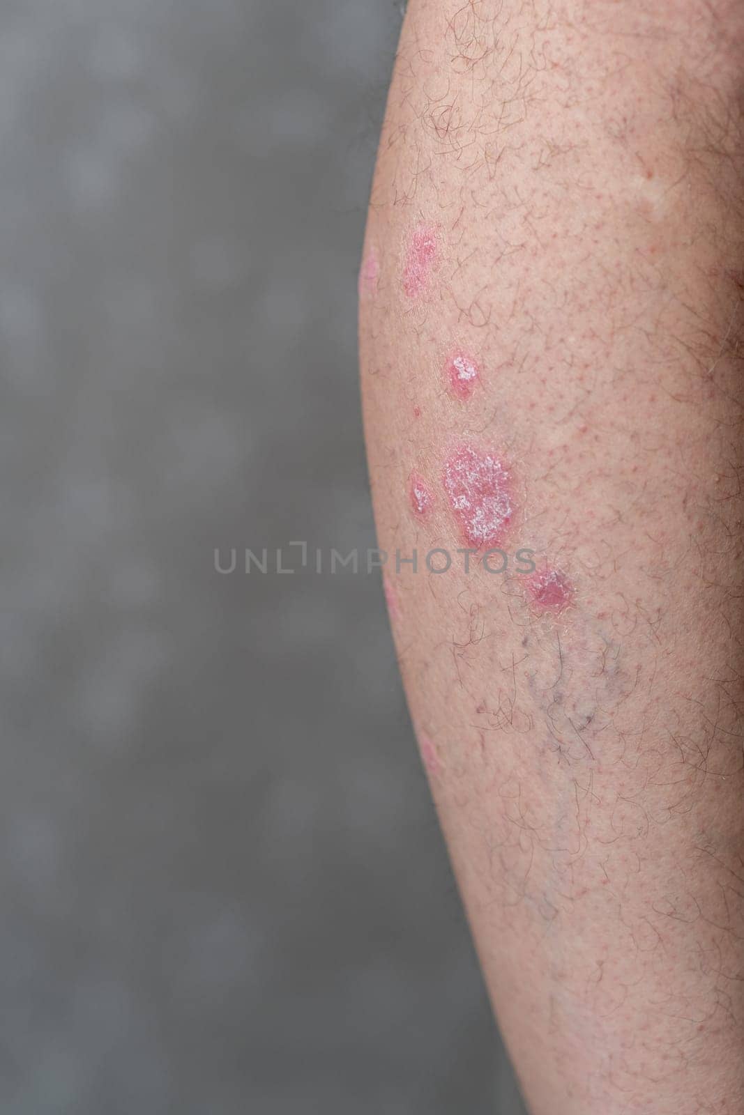 Psoriasis Vulgaris, skin patches are typically red, itchy, and scaly. by AnatoliiFoto