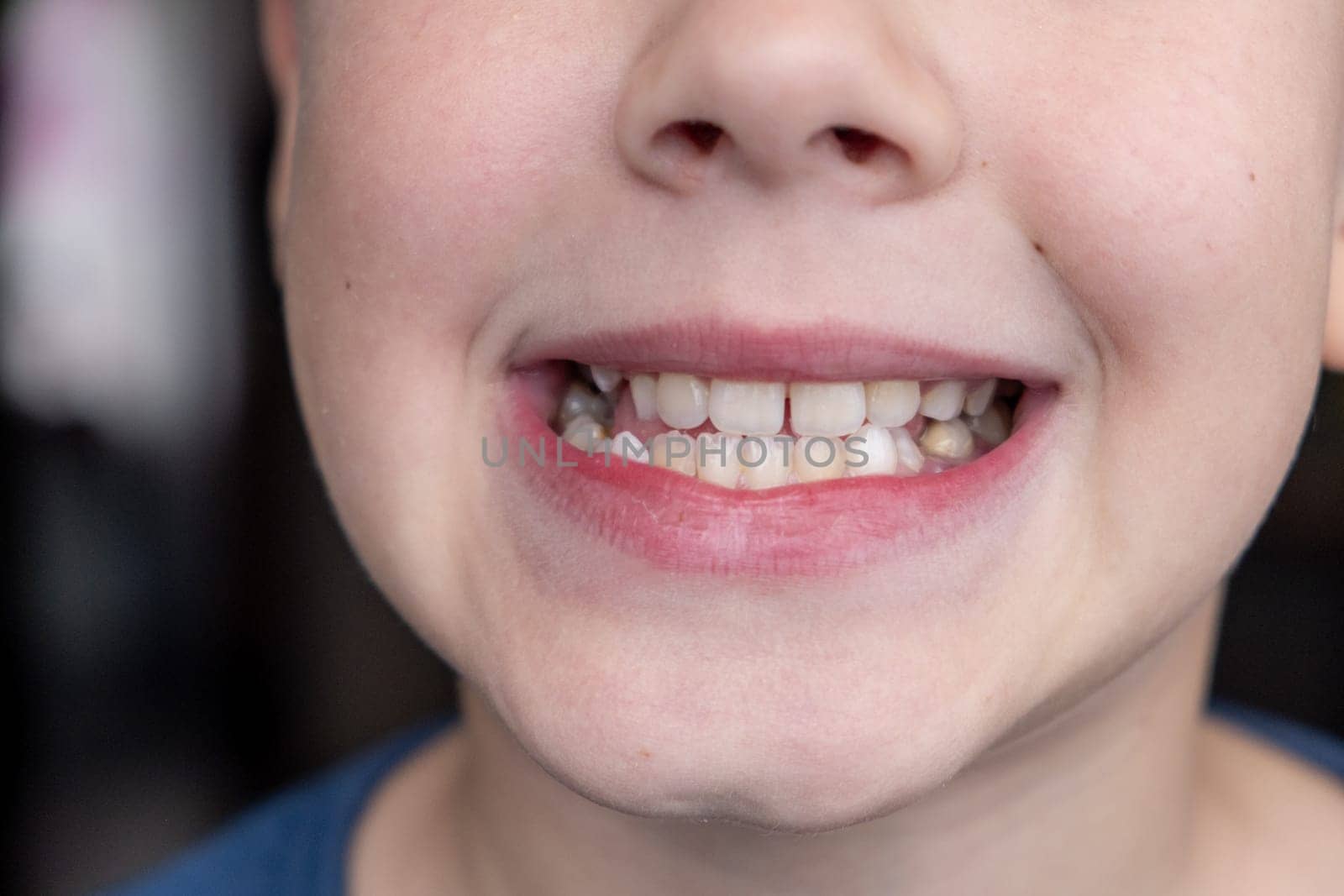 Child's crooked teeth. Young man showing crooked growing teeth. The child needs to go to the dentist to install braces.