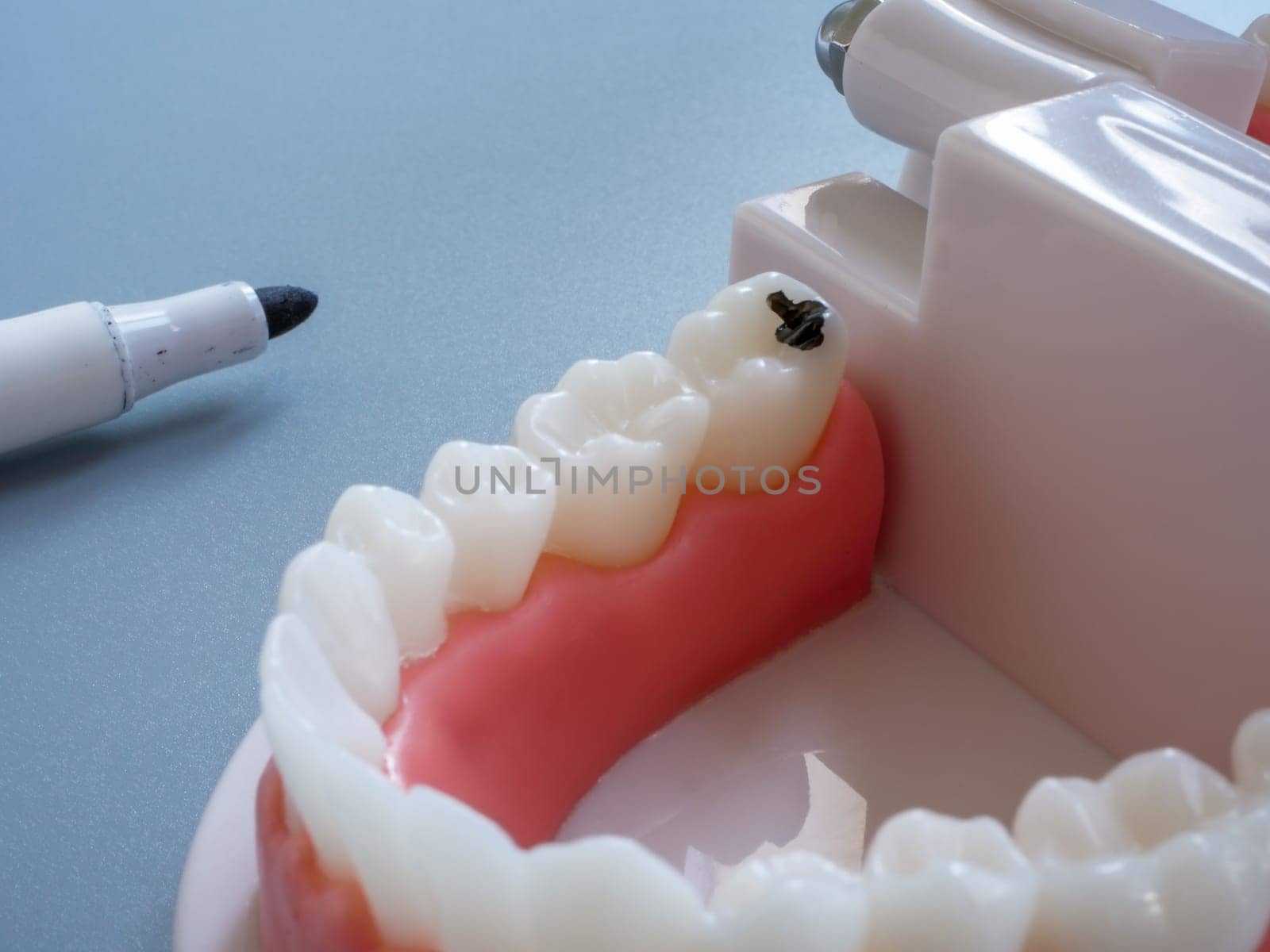 Model of a human jaw and a tooth marked as a sign of caries. Dental treatment.