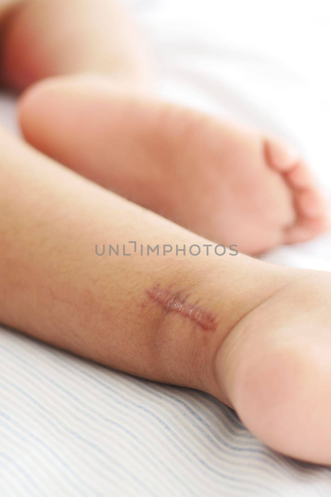 Stitched wound mark on a child foot