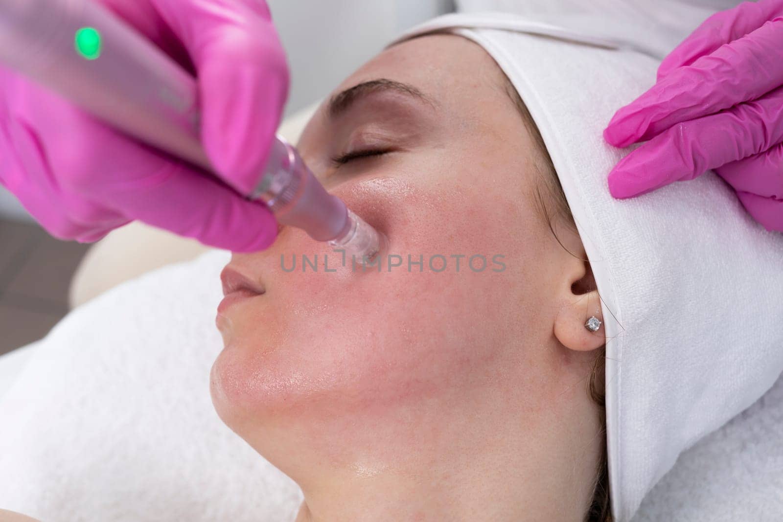 Closeup Cosmetologist Making Mesotherapy Injection With Dermapen On Face, Cheek Area Of Young Woman For Rejuvenation In Spa Center. Patient Getting Needle Mesotherapy, Skincare. Horizontal Plane.