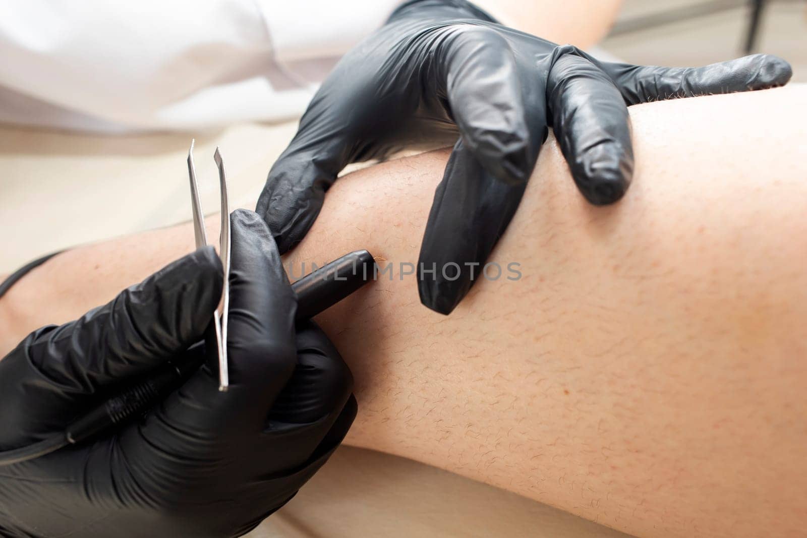 Unrecognizable Dermatologist Doing Hair Removal Electrolysis Procedure On Woman's Leg, Shin. Hirsutism, Excess hair. Electric Epilation In Beauty Salon. Authentic Photo. Horizontal Plane.