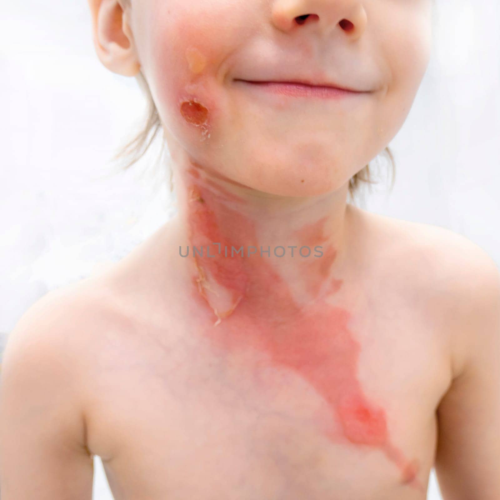 medical procedure dressing a boy with a first-degree burn from boiling water on his face, neck and chest