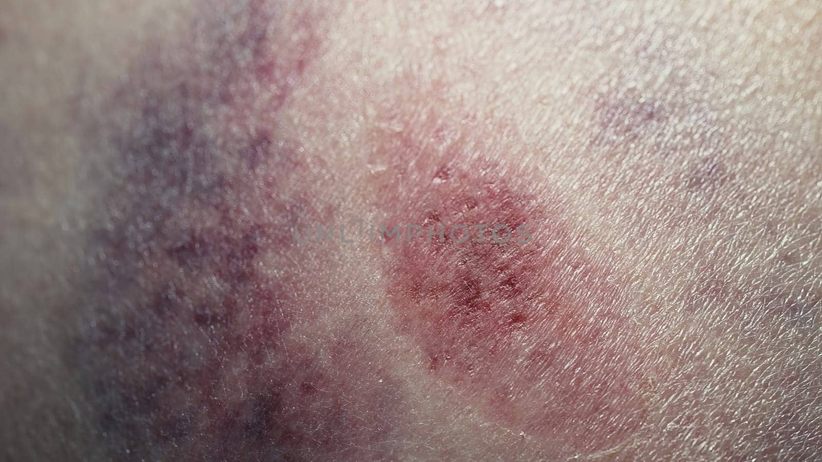 Big bruise hematoma after hit on human body skin. Congestion, macro. Health injury, pain, trauma concept. Domestic violence, home abuse by kristina_kokhanova