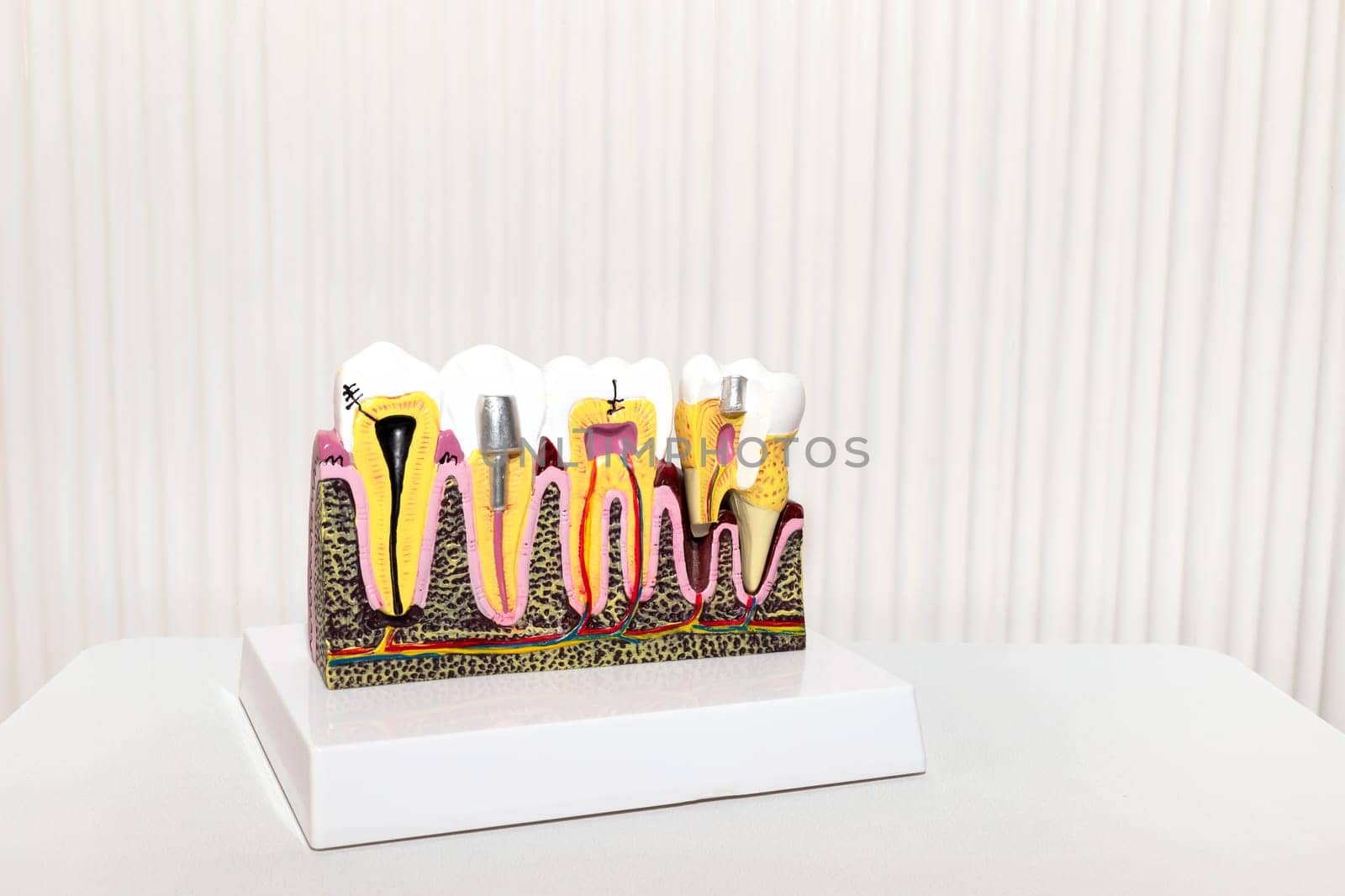 Dental Tooth Implant, Bridge Or Crown Model On White Background in Dental Office, Copy Space. Dummy Mockup Human Jaw Oral Dentures. Prosthesis On Metal Peg. Horizontal Plane. Dentistry, Education. by netatsi