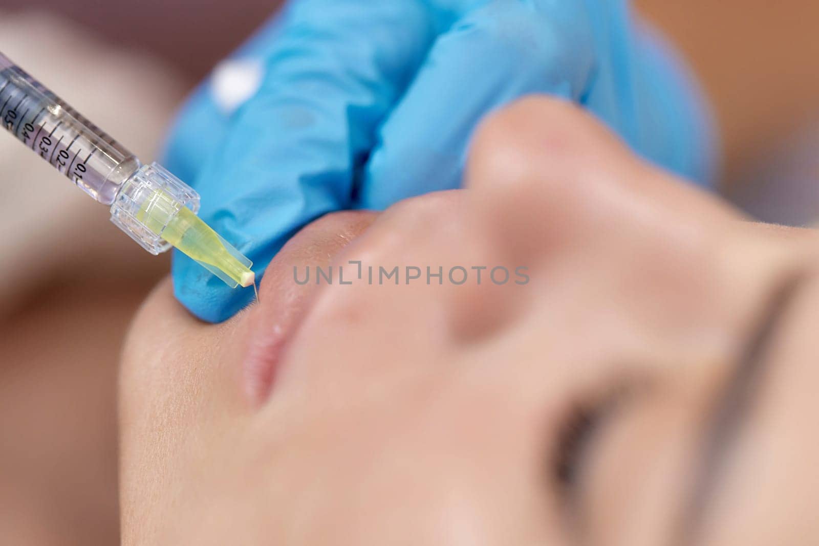 cosmetologist makes injections to enlarge the lips. Lips filler injection
