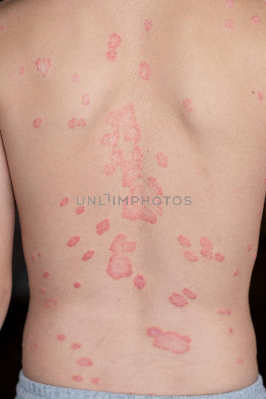 Psoriasis Vulgaris, skin patches are typically red, itchy, and scaly. by AnatoliiFoto