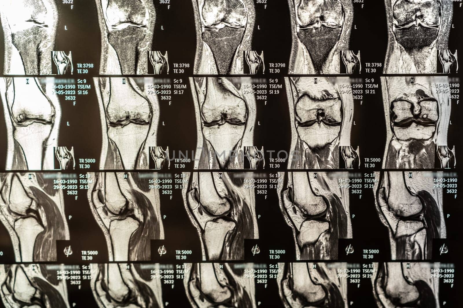 Knee joint x-ray or MRI. Doctor pointed on area of knee joint, where pathology or problem is detected, such fracture, destruction of joint, osteoarthritis.