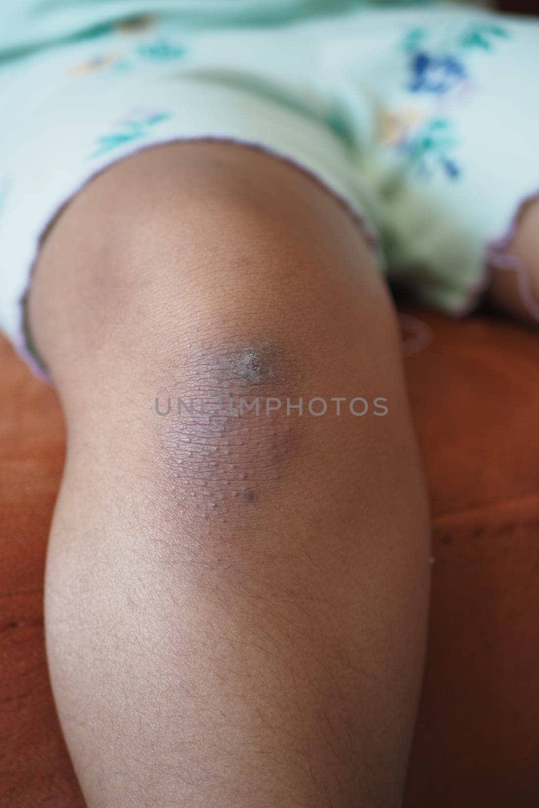 stain bruise wound on child knee