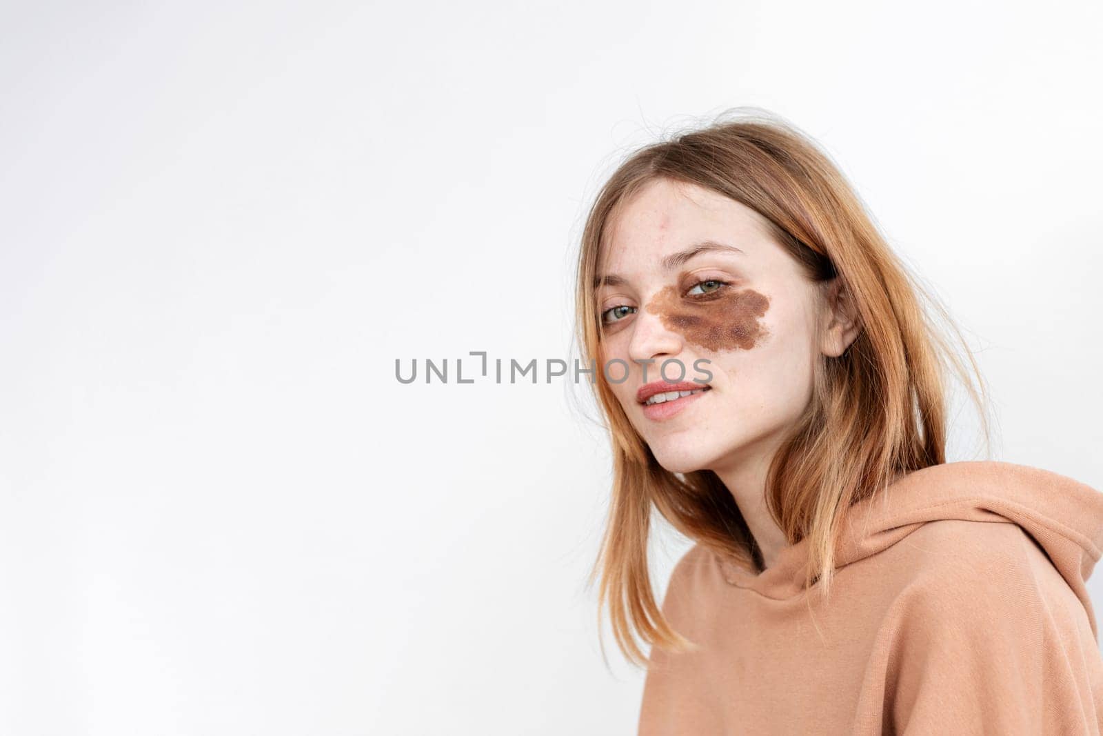 Portrait of a beautiful authentic girl light beige hoodie with birthmarks on her face No makeup by Demkat