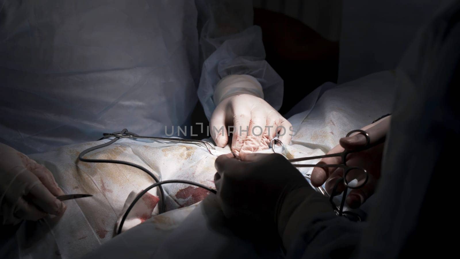 Surgical team operating male genitals in an operation theater. Close up of surgeons removing the tumor from the testicle of a man patient, cancer and medicine concept.