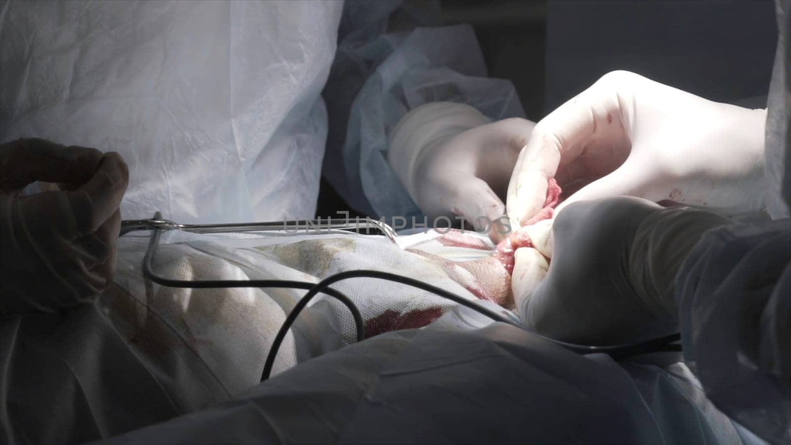 Close up detail of a surgery on male genitals with the professional equipment. Surgeons in sterile suits performing medical procedure, process of prostatectomy.