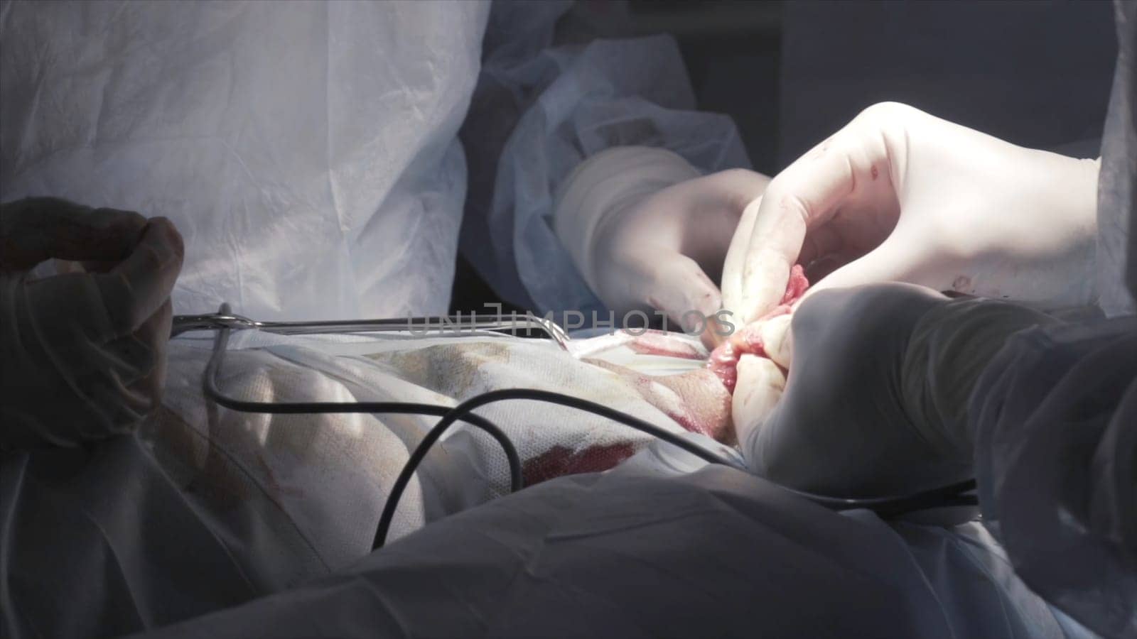 Close up detail of a surgery on male genitals with the professional equipment. Surgeons in sterile suits performing medical procedure, process of prostatectomy.