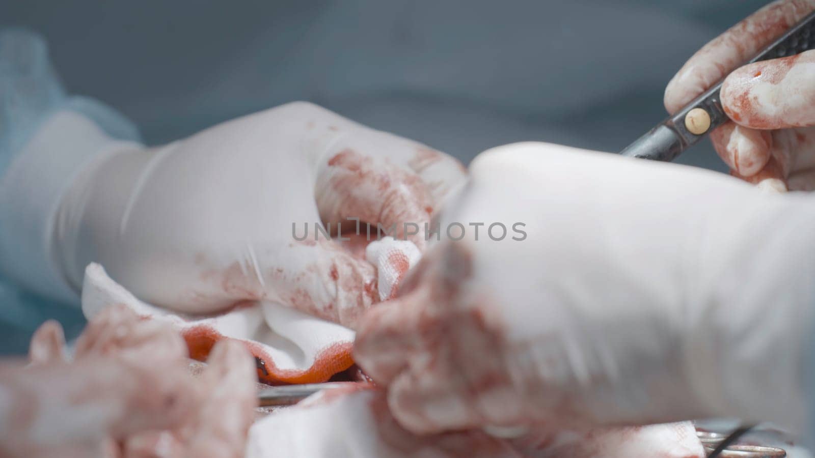 Operation on male organ. Action. Close-up of bloody operation on male sexual organ. Penis Enlargement Surgery.