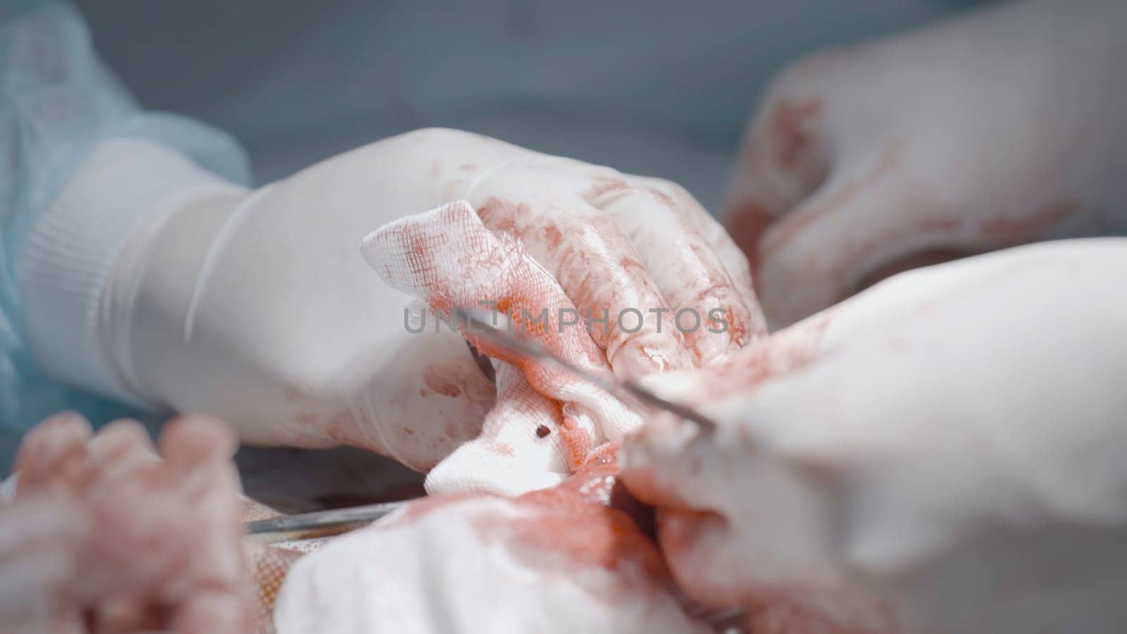 Operation on male organ. Action. Close-up of bloody operation on male sexual organ. Penis Enlargement Surgery.