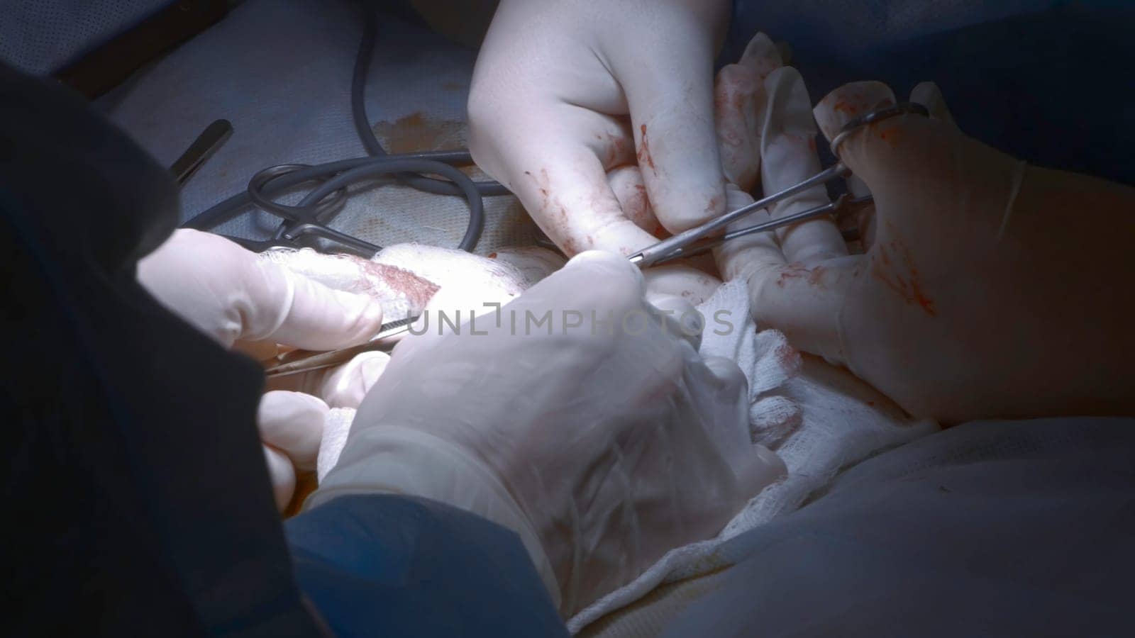 Close-up of surgeon performing operation. Action. Focused and serious surgery by surgeon. Professional surgeon at work on operation with anesthesia by Mediawhalestock