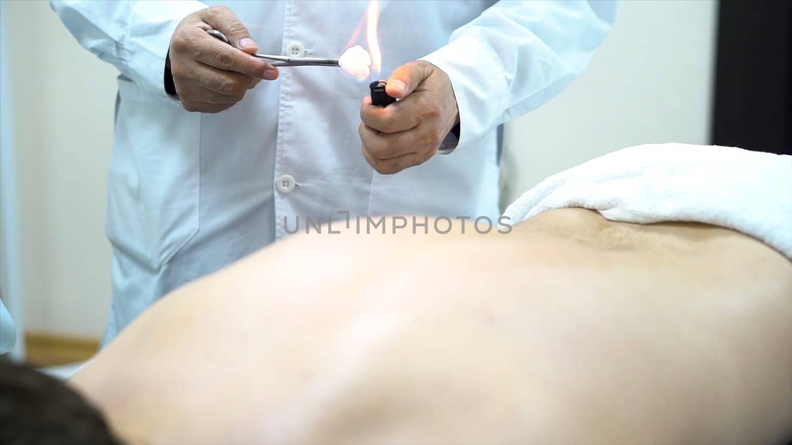 Acupuncture therapist placing a cup on the back of a male patient, ancient Chinese alternative medicine. Close up for a doctor giving cupping treatment on young man back