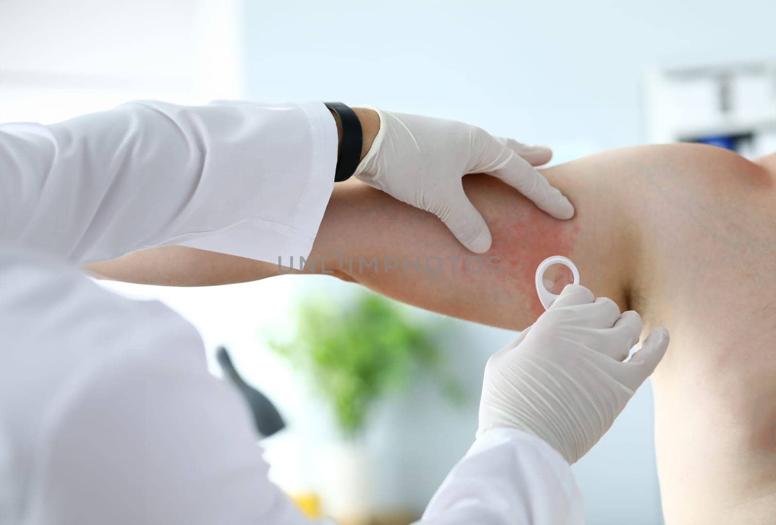 Focus on dermatological red rush spreading on bad skin of suffering patient sitting in modern office of smart dermatologist. Dermatology clinic advertisement concept. Blurred background