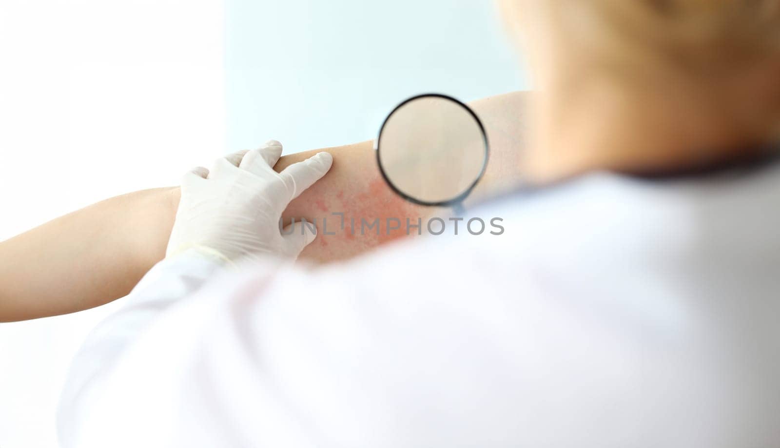 Focus on special magnifying glass used to precisely look at red rush on skin of suffering man with painful illness. Dermatology clinic advertisement concept. Blurred background