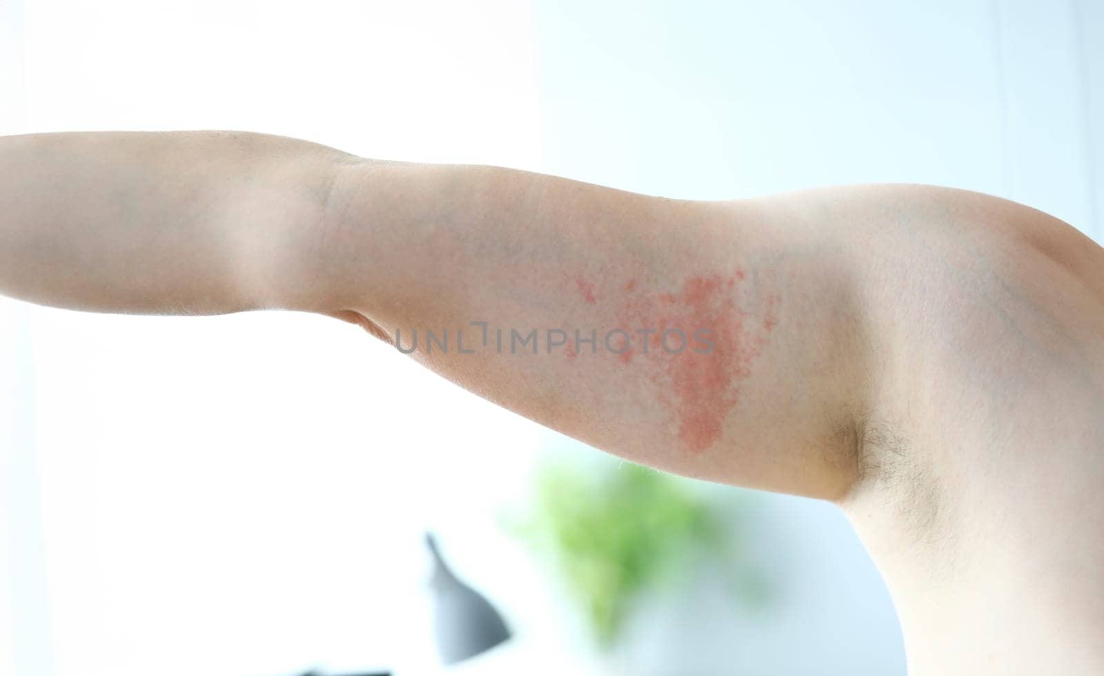 Focus on dermatological skin infection spreading throughout whole body of poor suffering patient. Professional dermatology clinic advertisement concept