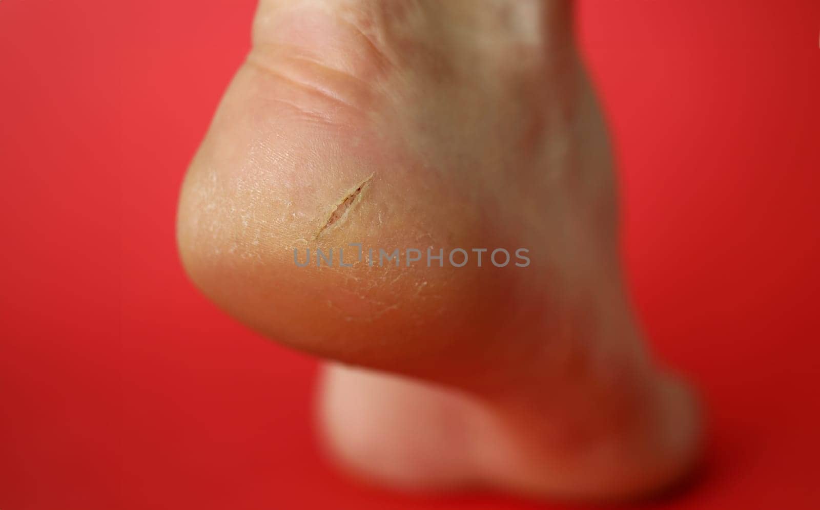 Close-up of female gam exposed to camera on lower view angle. Heel of dry leg covered with cracks. Moisturizing cream advertisement concept. Isolated on red background