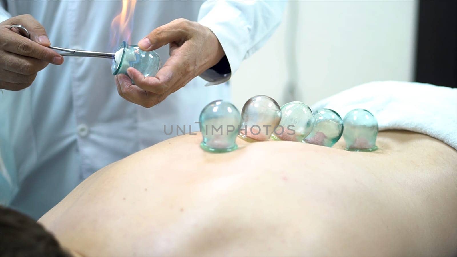 Acupuncture therapist placing a cup on the back of a male patient, ancient Chinese alternative medicine. Close up for a doctor giving cupping treatment on young man back