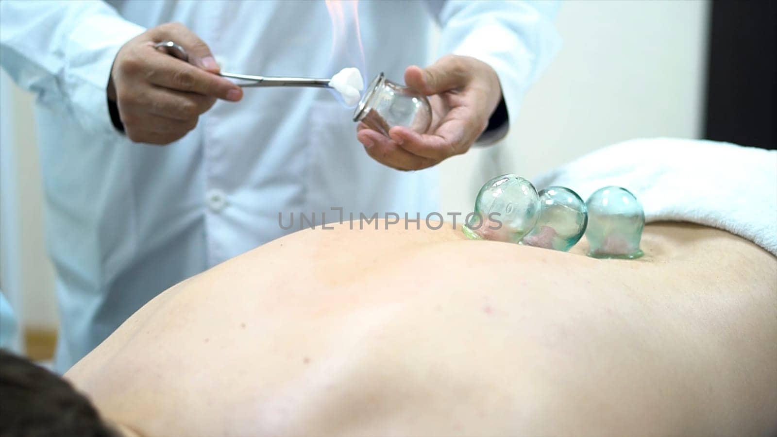 Acupuncture therapist placing a cup on the back of a male patient, ancient Chinese alternative medicine. Close up for a doctor giving cupping treatment on young man back
