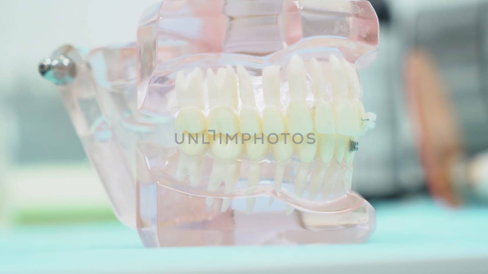 Close-up of denture jaw. Media. Denture of jaws with teeth with transparent gums stands on table in dental office. Modern design of jaw prosthesis.